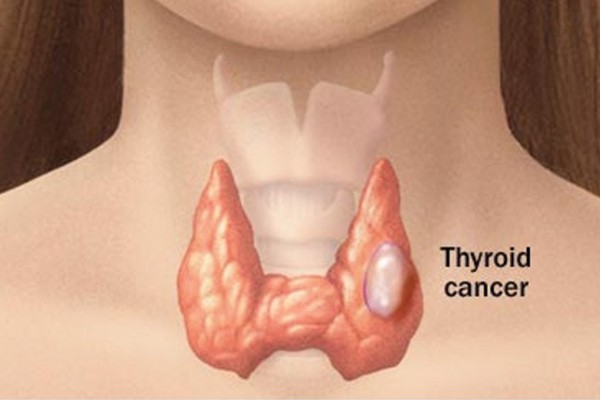 Thyroid Cancer and Goiter Surgery