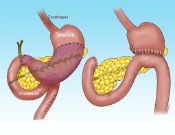 Stomach Cancer Surgery